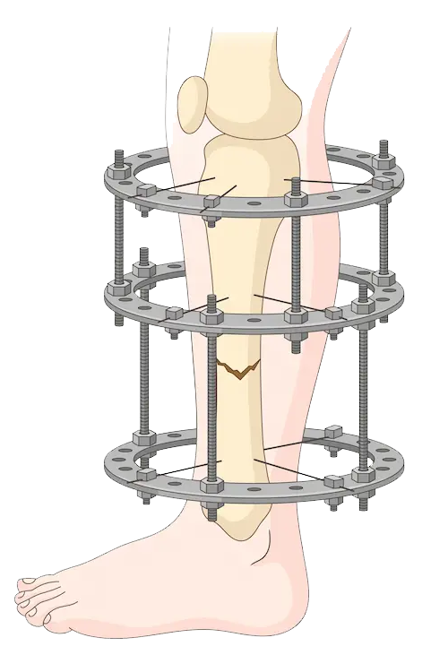 Limb Lengthening and Ilizarov Surgery